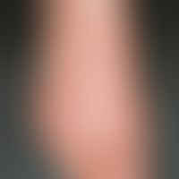 Chronic allergic contact dermatitis: scattering contact allergic eczema in the area of the back o...