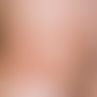 Contact dermatitis: Acute contact allergic eczema with fresh blisters in the wrist crease area.
