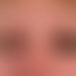 Kontaktdermatitis: Stark lichenifizierte Ekzemplaques im Bereich der Ober- und Unterlider bei chr...
