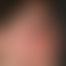 Contact dermatitis allergic: acute, itchy, relatively sharply defined, photoallergic (contact) de...