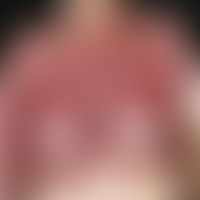 Contact dermatitis allergic: multiple, acute, continuously progressive for 4 weeks, large, isolat...
