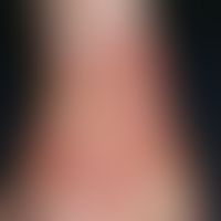 Acute allergic contact dermatitis: 6 days ago, the first acute, itchy, blurred erythema on the le...