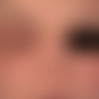 Kontaktdermatitis allergische: Zustand nach Applikation eines Haarfärbemittels. 1 Tag später mass...