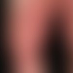 Kontaktdermatitis toxische: scharf begrenzte, großflächige, akute, juckende und brennende Dermati...