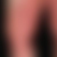 Contact dermatitis toxic: sharply defined, large-area, acute, itching and burning dermatitis, 6 h...
