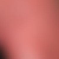 Kontaktdermatitis toxische: Ausschnittsvergrößerung: flächige Rötung und Schwellung, stellenweise...