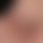 Kontaktdermatitis toxische: Detailvergrößerung: Kräftige Hyperkeratosen auf geröteter Haut sowie ...