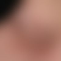 Contact dermatitis toxic: Detail enlargement: Severe hyperkeratosis on reddened skin as well as i...