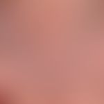 Kontaktdermatitis toxische: Detailvergrößerung: Kräftige Hyperkeratosen auf geröteter Haut sowie ...