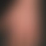 Kontaktdermatitis, toxische: Hyperkeratosen auf entzündlich veränderter Haut am rechten Handgelen...