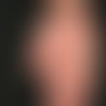 Kontaktdermatitis toxische: Übersichtsaufnahme: Hyperkeratotisch-rhagadiformes Kontaktekzem mit f...