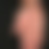 Kontaktdermatitis toxische: Übersichtsaufnahme: Hyperkeratotisch-rhagadiformes Kontaktekzem mit f...