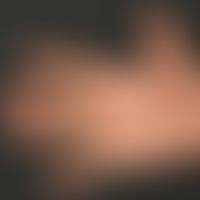 contact dermatitis, toxic: overview picture: hyperkeratotic-rhagadiform eczema of the Palma in a ...
