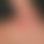 Kontaktdermatitis toxische: Detailvergrößerung: Hyperkeratotische Plaques und Rhagaden an der rec...