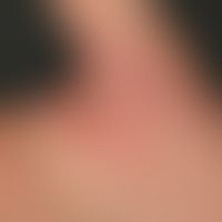 Contact dermatitis toxic: Detail enlargement: Hyperkeratotic plaques and rhagades on the right pa...