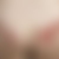 contact dermatitis toxic: 41-year-old female patient who noticed these painful striated red plaqu...
