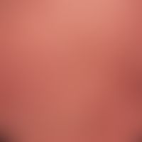 Contact dermatitis, toxic: Severe, not quite fresh, painful dermatitis after application of an oi...