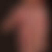 Handdermatitis: chronische, dyshidrotische Dermatitis der Hand. Groblamelläre Abschuppung der Han...