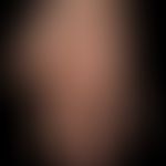 Hand eczema atopic: flateczema reaction, fuzzy border to hand lobe (important differential diagno...