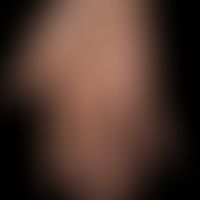 Hand eczema atopic: flateczema reaction, fuzzy border to hand lobe (important differential diagno...