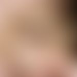 dyschromia. brown, universally smooth spot, in light-exposed areas additionally intensified (dysc...