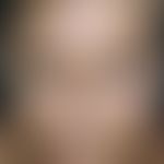 Dyschromia: Diffuse, yellowish-brown discoloration of the skin, in this case with underlying meta...