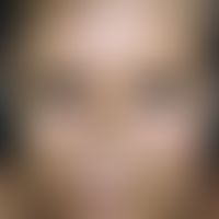 Dyschromie. Diffuse, gelbbraune Verfärbung der Haut, im vorliegenden Fall bei zugrunde liegendem ...