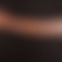Graft-versus-Host-Disease: brownish pigmented, partly also scleroderma-like skin changes in the a...
