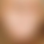 Kaposi's sarcoma: Multiple, chronically stationary, asymptomatic, non-painful, bluish-violet colo...