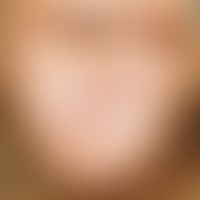 Kaposi's sarcoma: Multiple, chronically stationary, asymptomatic, non-painful, bluish-violet colo...