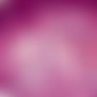 Kaposi's sarcoma: Lymphangioma-like variant of Kaposi's sarcoma; irregular, partially anastomosin...