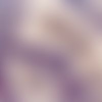Kaposi's sarcoma. Irregular vessel with septa extending deep into the vascular lumen. Prominent e...