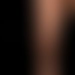 Kaposi's sarcoma endemic: chronically stationary, flat, along the skin cleavage lines localized, ...