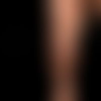 Kaposi's sarcoma endemic: chronically stationary, flat, along the skin cleavage lines localized, ...