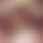 Kaposi's sarcoma Multiple, chronically stationary, livid-red to bluish plaques on the palate in a...