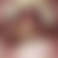 Kaposi's sarcoma Multiple, chronically stationary, livid-red to bluish plaques on the palate in a...
