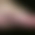 Kaposi's sarcoma. chronic (classic) Kaposi's sarcoma, 75-year-old turkish pat. with several years...