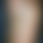Kaposi's sarcoma. 80-year-old patient with CML, which has been known for many years, has reddish-...