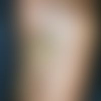 Kaposi's sarcoma. 80-year-old patient with CML, which has been known for many years, has reddish-...
