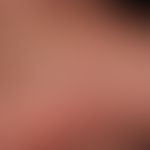Kaposi's sarcoma HIV-associated
