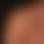 Kaposi's sarcoma HIV-associated: disseminated, reddish-brown, completely symptom-free spots and p...