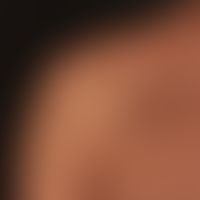 Kaposi's sarcoma HIV-associated: disseminated, reddish-brown, completely symptom-free spots and p...