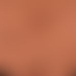 Kaposi's sarcoma endemic: Close-up with reddish-brown, bizarrely configured, longitudinally align...