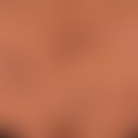 Kaposi's sarcoma endemic: Close-up with reddish-brown, bizarrely configured, longitudinally align...