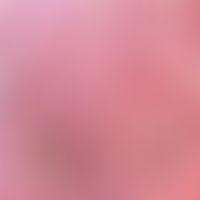Kaposi sarcoma: HIV-induced (HHV-8 detection)
