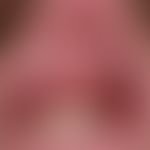 Kaposi sarcoma, HIV-induced
