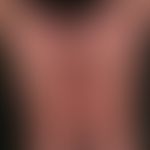 Steroidatrophie der Haut. Langjährige interne und lokale (Steroidspray wegen Asthma bronchiale)&n...