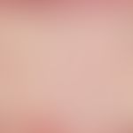 Alopezie. Vernarbende Alopezie. Weitgehend unverändertes Oberflächenepithel. Im Zentrum des Biopt...