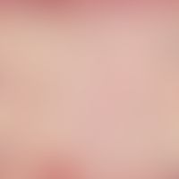 alopecia. scarring alopecia. largely unchanged surface epithelium. in the center of the bioptate ...