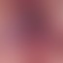 Melanom, malignes, Schleimhautmelanom. Zufallsbefund eines nodulären Schleimhautmelanoms bei eine...